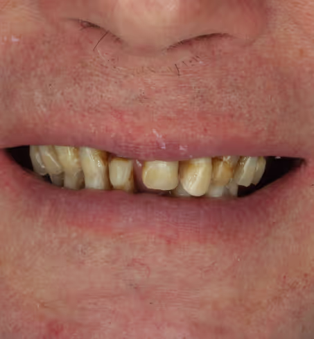 Улыбка до лечения